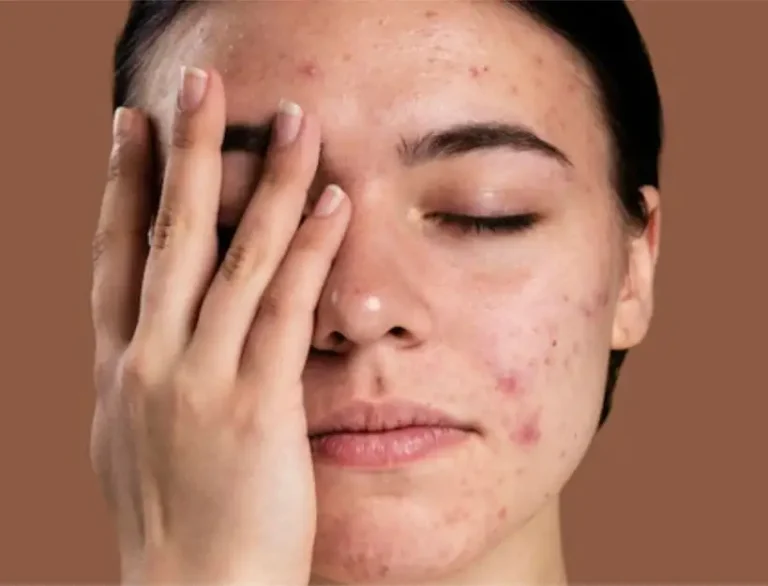 how to get rid of dark spots on face fast