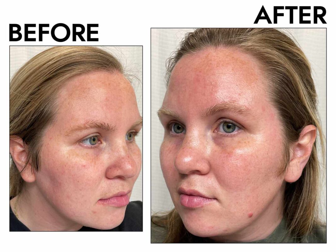 best exfoliators for clogged pores and blackheads