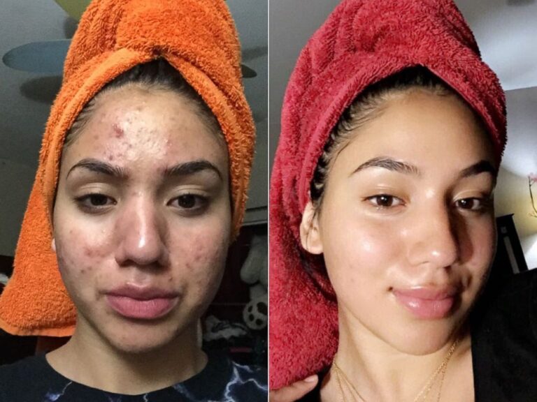 skincare routine for teenagers with acne