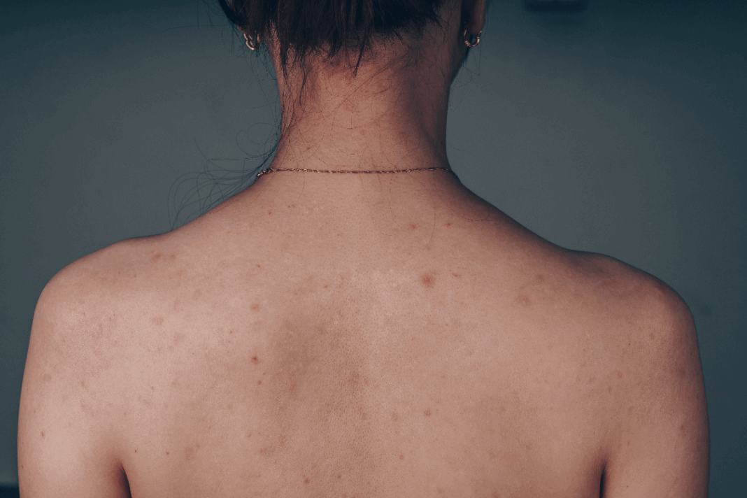 how to get rid of back acne scars fast